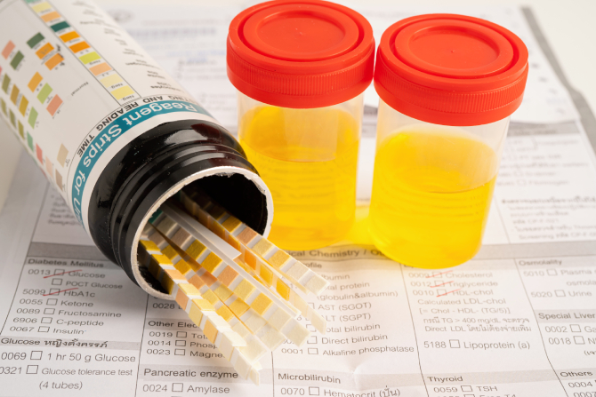 Frascos de con orina y tiras para detectar droga en el organismo. 