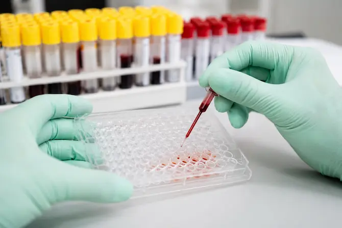 Manos con guantes sosteniendo reactivo para detección de anticuerpos en muestra de suero